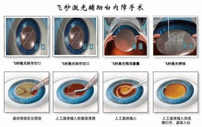 白内障手术示意图图片