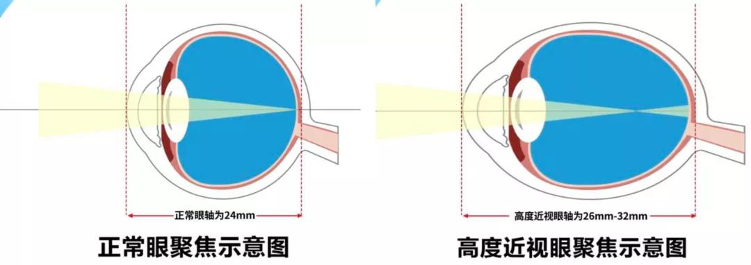 高度近视眼轴与正常眼轴_太原康明眼科近视手术中心.png